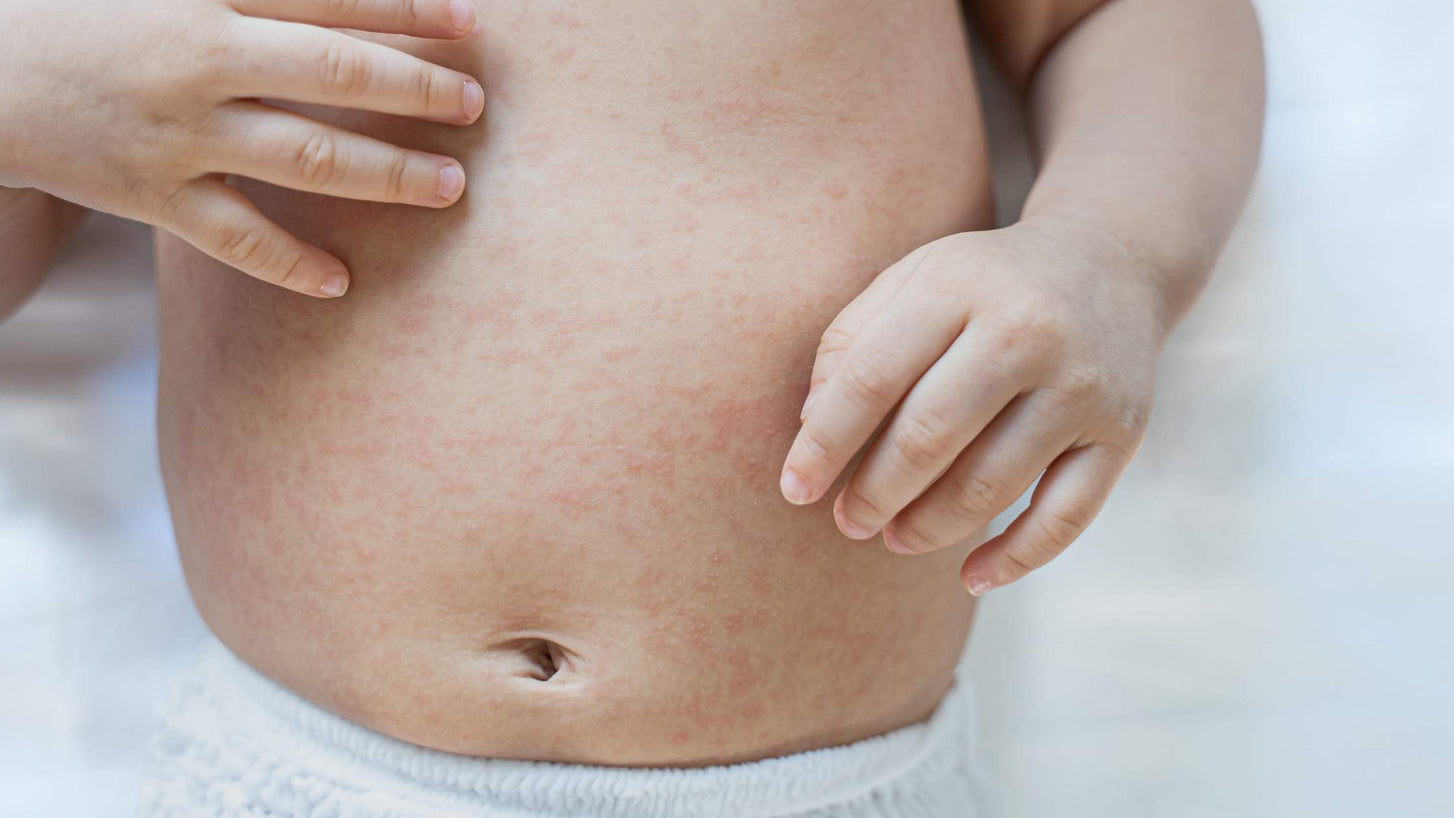 Baby Eczema 