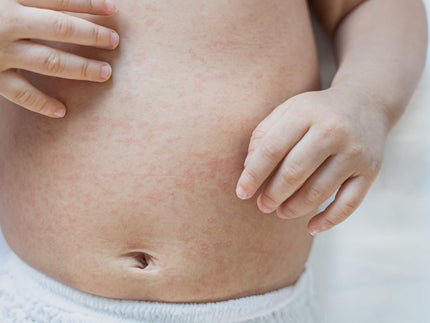 Managing Baby Eczema: Tips and Treatments for New Parents 